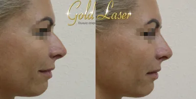 Контурная пластика носа в Киеве: цены, отзывы в клинике Gold Laser