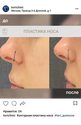Контурная пластика носа, цены в Москве
