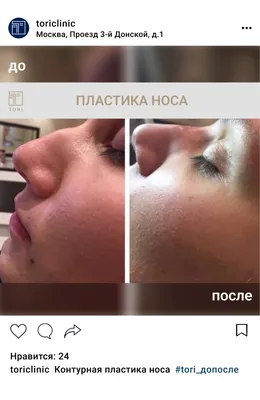 Контурная пластика носа, цены в Москве