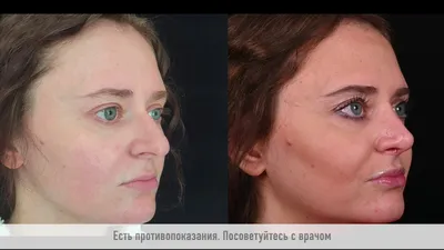 Ринопластика кончика носа, пластика носа цена в клинике в Москве