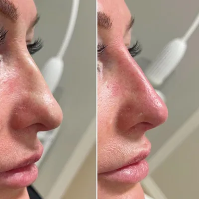 Коррекция формы носа - Клиника красоты Nord Skin Clinic