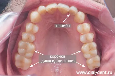 Коронки из диоксида циркония (в том числе на имплантах) для протезирования  жевательных зубов