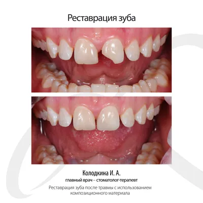 Коронка из диоксида циркония - цена в Ижевске