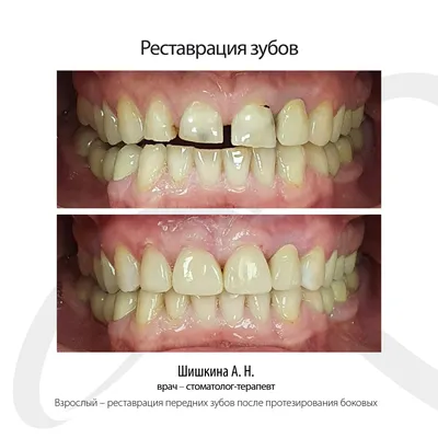 Коронка из диоксида циркония - цена в Ижевске