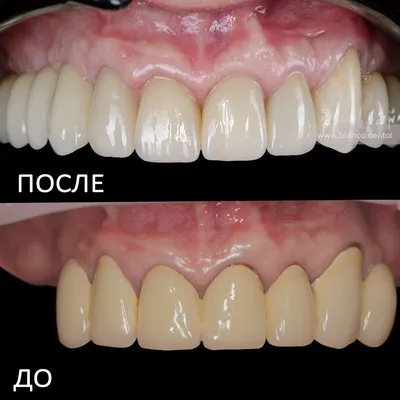 ᐉ 👏🏼 Замена старых коронок на безметалловые коронки из оксида циркония ⭐️  | Стоматология «Бланко» Днепр