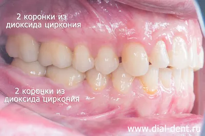 Коронки из диоксида циркония (в том числе на имплантах) для протезирования  жевательных зубов