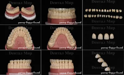 Тотальное протезирование безметалловыми коронками из диоксида циркония и  виниры E-max при стираемости зубов