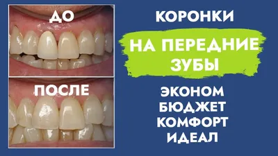 Коронки на передние зубы до и после фото