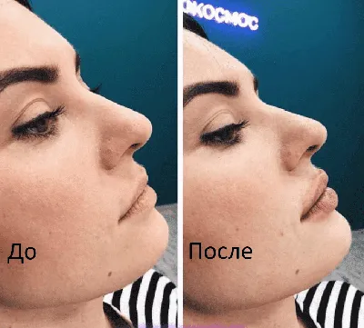 Увеличение губ в Москве: цены на коррекцию губ в косметологии 💫 KOSMOS