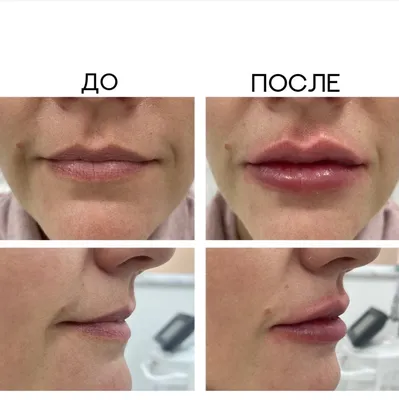 Увеличение губ - Медицинская косметология «Водолей»