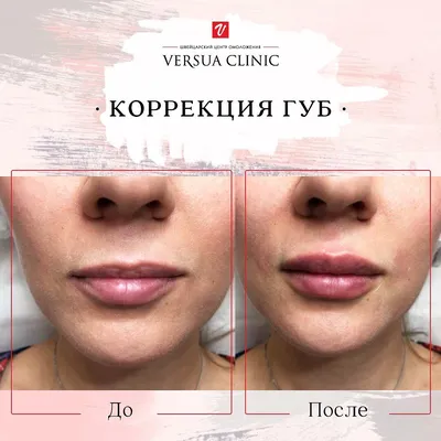 Увеличение и коррекция формы губ в Москве в Versua Clinic, цены на  увеличение губ, отзывы