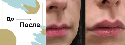 Увеличение губ l Фото до и после