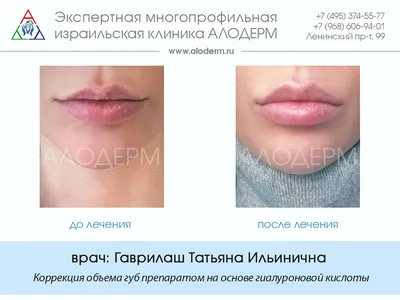 Коррекция формы губ методом контурной пластики | Клиника АЛОДЕРМ , Москва