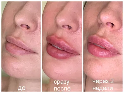 Как выглядят губы через 2 недели после введения филера/увеличения —  vzbeauty.ru