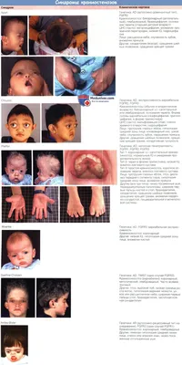 Краниосиностоз у ребенка и изменения глазницы при нем