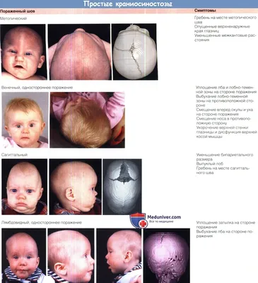 Краниосиностоз у ребенка и изменения глазницы при нем