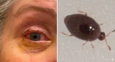Tiny bug causing 'horrendous' eye condition during Aussie summer