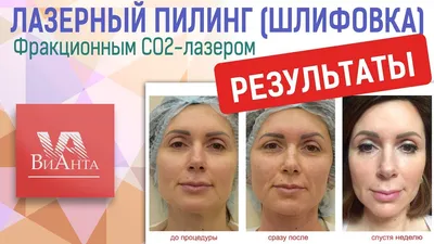 ▷ Лазерная шлифовка лица ➡️ Отзывы в Киеве — Coolaser Clinic