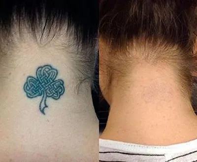 Удаление татуировок пикосекундным лазером Picosure - Vip Clinic.  Пикосекундный лазер удаление тату в Москве. Доступныей цены