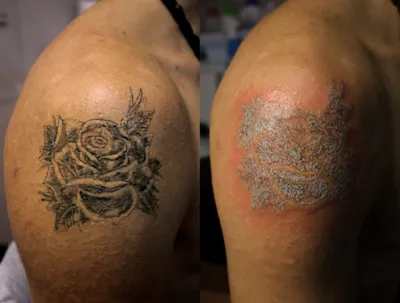 Последствия лазерного удаления татуажа: ошибки и как их избежать