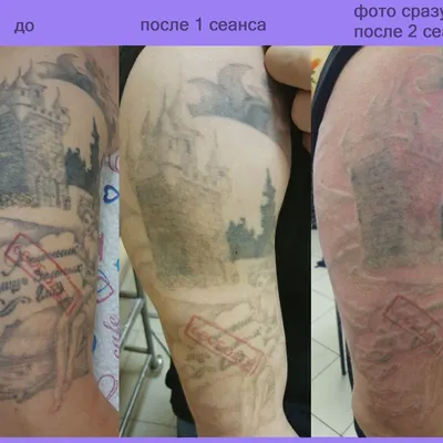 Удаление тату лазером | Свести татуировку в Екатеринбурге