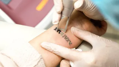 Лазерное удаление татуировки - безопасный способ избавиться от неудачного  рисунка | iNKPPL