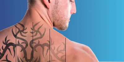 Лазерное удаление татуировки: что стоит знать, прежде чем решиться -  Лайфхакер