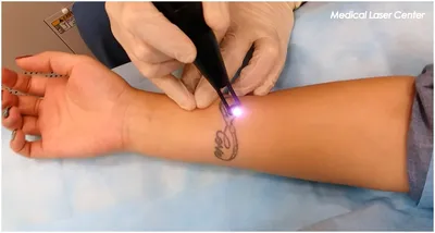 🥇 Удаление татуировок лазером в Алматы: Цена, Отзывы. Лазерное выведение  тату — MLC