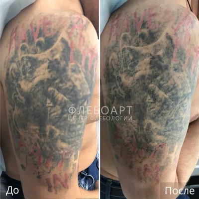 Удаление татуировок и татуажа лазером в Краснодаре: быстро и недорого