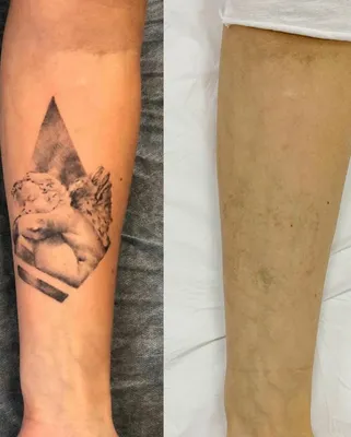 Что стало с ангелом на плече у Анны, после того как она попробовала лазерное  удаление (фото до и после) | Etlaser - Удаление татуировок | Дзен