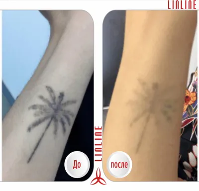 Удаление тату | Лазерное удаление татуировок в Минске | Клиника LINLINE