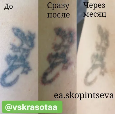 Лазерное удаление татуировок и перманентного макияжа фотографии до и после  в Оренбурге в ЦЭМ \"Вселенная гармонии и красоты\"