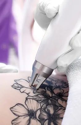 Удаление татуировок пикосекундным лазером Picosure - Vip Clinic.  Пикосекундный лазер удаление тату в Москве. Доступныей цены