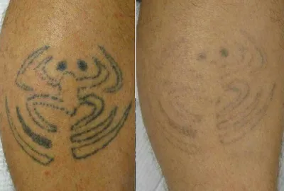 Лазерное удаление татуировок - Altos Klinika