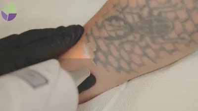 Удаление тату до и после. Как удалить татуировку. Удаление тату лазером. Лазерное  удаление - YouTube