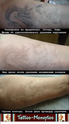 Удаление татуажа и татуировок лазером в Донецке. - тату салон  \"Tattoo-Moneytoo\" в Донецке