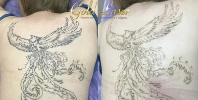 Лазерное удаление татуажа и татуировок в Киеве: цены, отзывы | клиника Gold  Laser