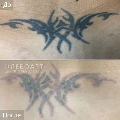 Удаление татуировок и татуажа лазером в Краснодаре: быстро и недорого