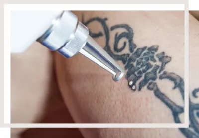 BeUnique — клиника инновационной косметологии » Лазерное удаление татуировок  и татуажа Q-swithed Nd:YAG