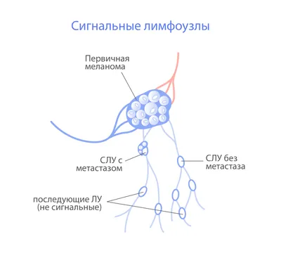 Биопсия сторожевого (сигнального) лимфоузла