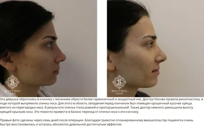 Липофилинг лица (скул, подбородка, щек, лба): сделать операцию в Москве |  Цены, фото до-после, отзывы | Клиника Beauty Space Clinic