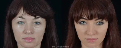 Липофилинга лица фото до и после | Клиника Доктора Гришкяна | - Страница 3  из 5