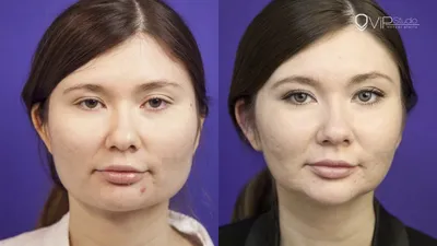 Малярпластика до и после фото