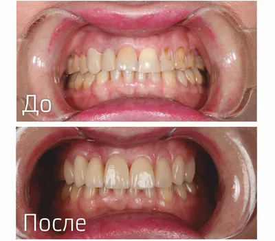 Протезирование коронками - ООО «Центр Стоматологии 32 Практика»