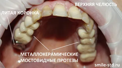 Коронки на зубах занизили прикус и разрушили другие зубы – клиника Smile  STD, Москва