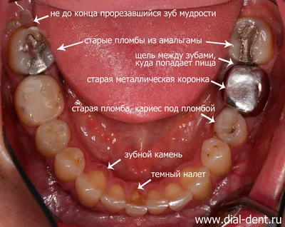 Замена старой металлокерамики на коронки из оксида циркония