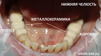 Коронки на зубах занизили прикус и разрушили другие зубы – клиника Smile  STD, Москва