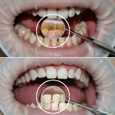 Профессиональная и безболезненная чистка зубов в Мытищах