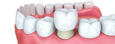 Коронки на жевательные зубы: какие лучше ставить? Стоматология Dental Way в  Москве и Московской области | Dental Way