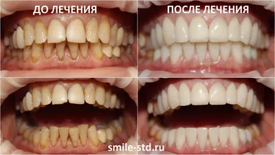 Установка виниров и коронок женщинам после 50 лет. Клиника Smile STD в  Измайлово